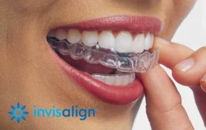 A woman putting an invisalign aligner in her mouth