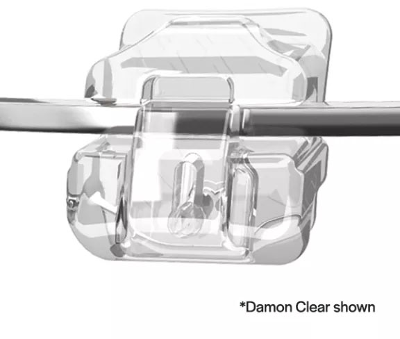 Clear Damon Braces Mechanics