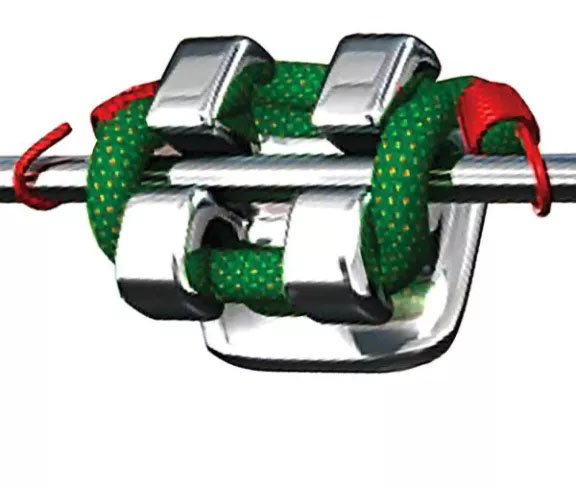 Traditional Braces Mechanics