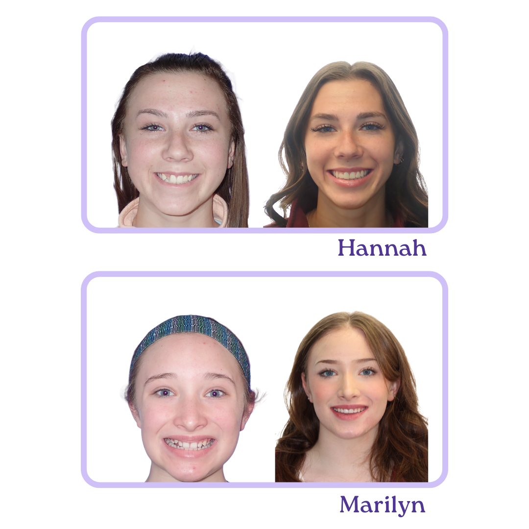 Two smile before and afters are shown. On top is Hannah's and on bottom is Marilyn's